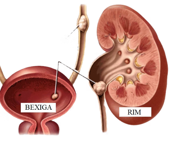 Ilustração de cálculo renal no rim, no ureter e na bexiga