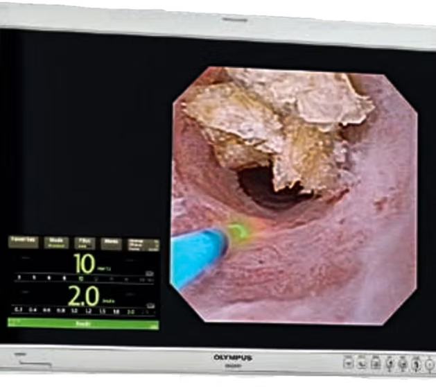 Cirurgia endoscópica a laser de cálculo urinário em monitor de vídeo